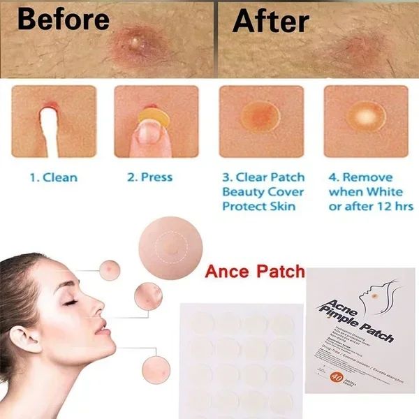 Acne Patch Sheets